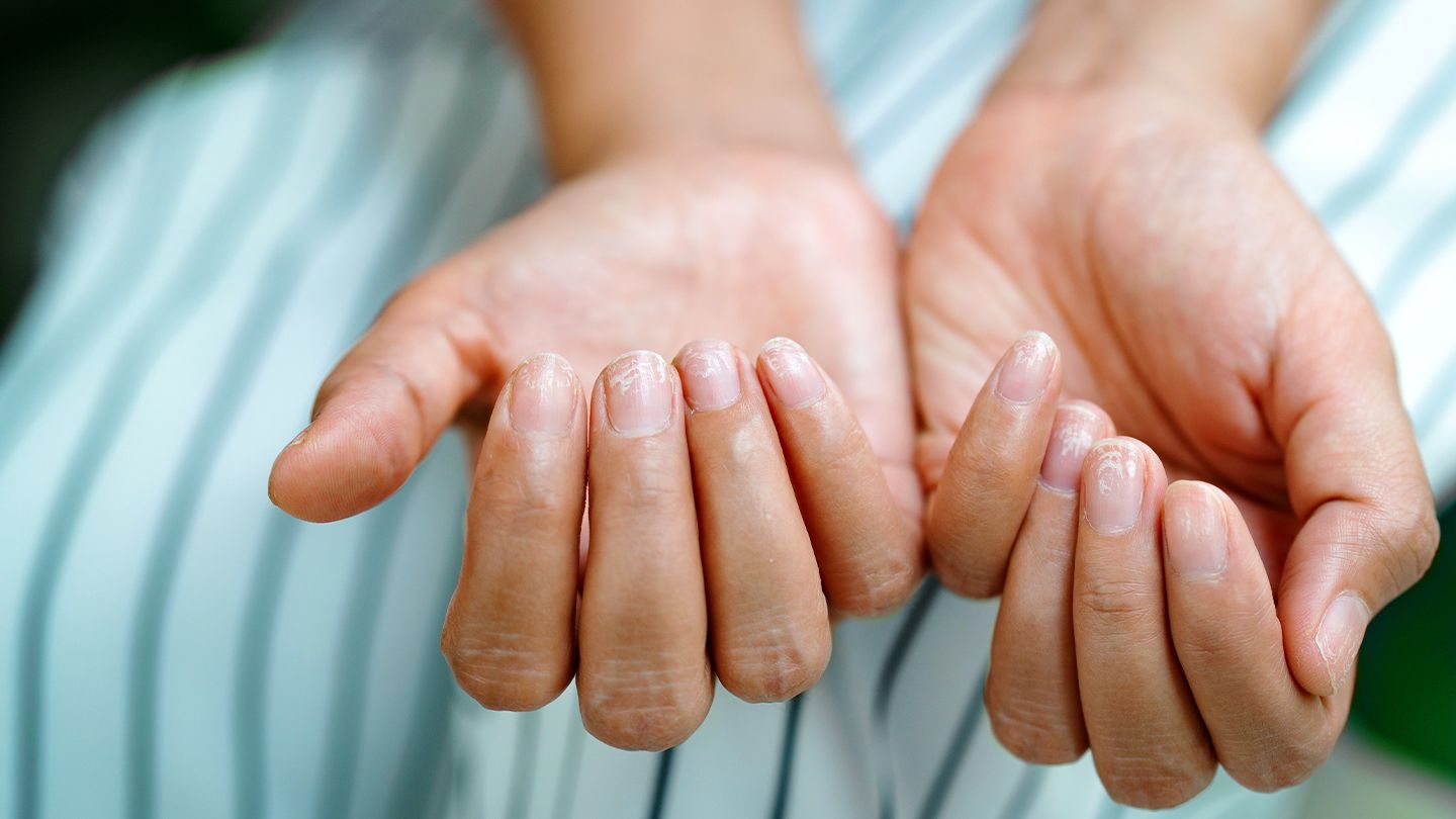 Ongles cassants et carence en vitamines : ce qu'il faut savoir